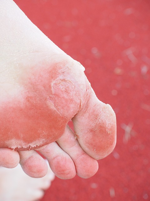 How To Treat Blood Blister Under Callus Dermanities
